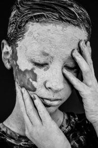 幼児のアトピーによる色素沈着はいつ消えるのか？